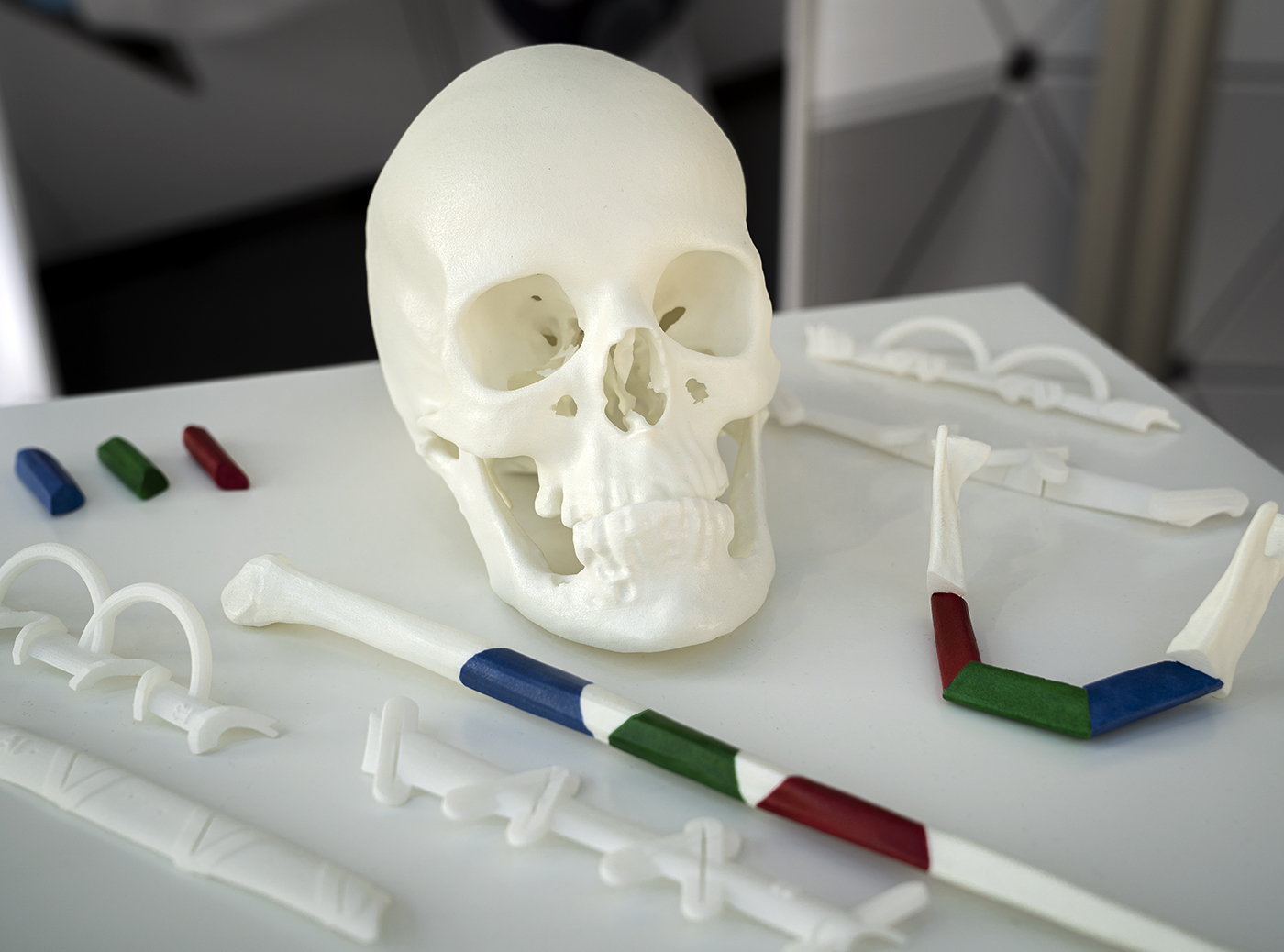 3D-gedruckte Cutting Guides